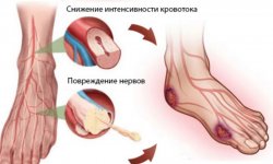 Диабетическая стопа профилактика