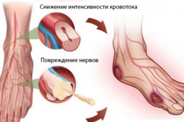 Диабетическая стопа профилактика