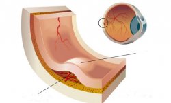 Диабетический макулярный отек: как избавиться от него