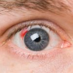 кровоизлияние в глаз при диабете