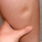 лечение отеков при диабете