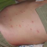 Кожные высыпания при сахарном диабете